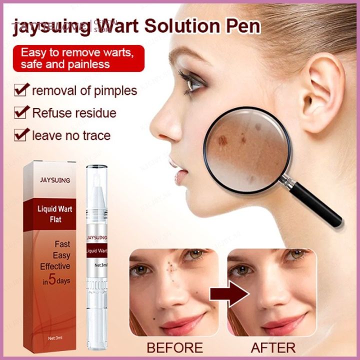 Body Wart Remove Pen
